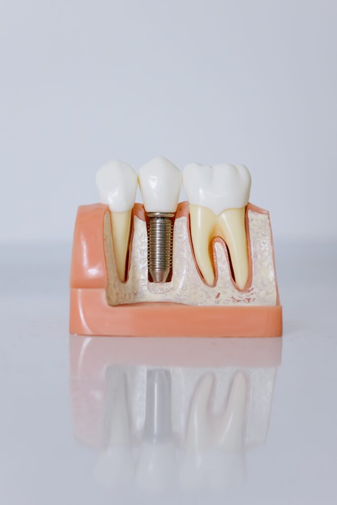 rappresentazione di impianti dentale nell'osso